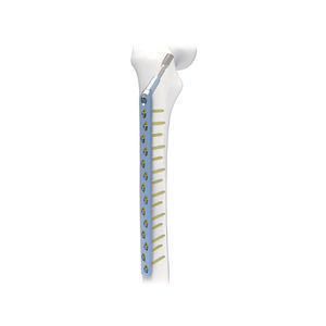 placca di compressione per femore 1