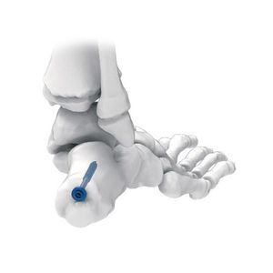 vite per compressione ossea per calcagno 1