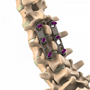 sistema di osteosintesi toraco-lombare