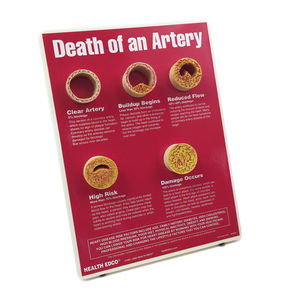 modello anatomico dell'arteriosclerosi