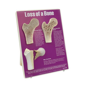 kit di presentazione di modello anatomico di osteoporosi