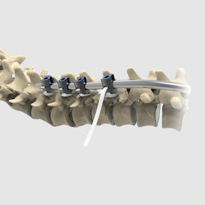 fascia di fissaggio spinale posteriore pediatrica