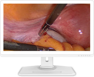 monitor per endoscopia