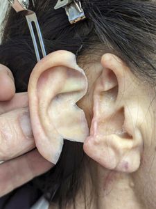 protesi estetica padiglione auricolare 1