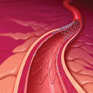 stent coronarico 1
