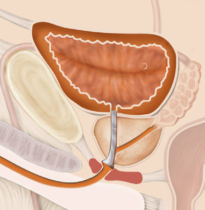 stent prostatico