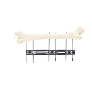 fissatore esterno per tibia