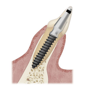 impianto dentale cilindrico