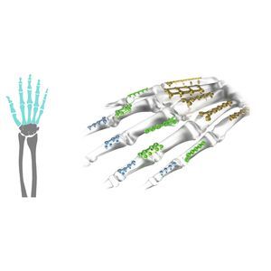 placca di compressione per falange della mano