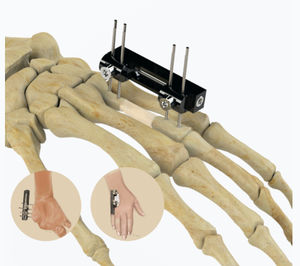 fissatore esterno per articolazione metacarpo-falangea 1