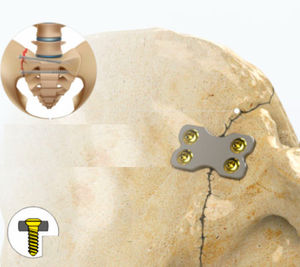 placca di compressione per articolazione sacro-iliaca 1