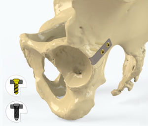 placca di compressione per acetabolo
