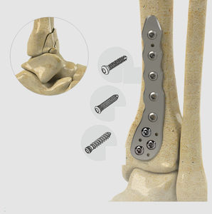 placca di compressione per tibia 1