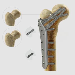 placca di compressione per femore 1