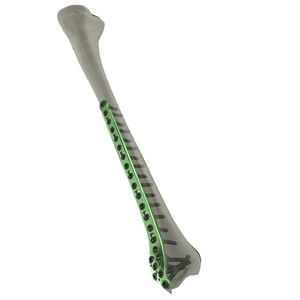 placca di compressione per tibia 1