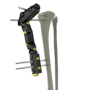 fissatore esterno per tibia 1