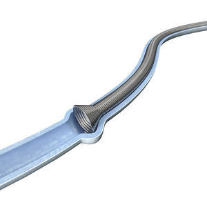stent ureterale 1
