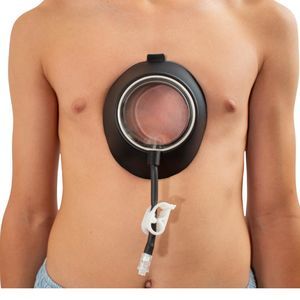 vacuum bell per correzione del pectus excavatum