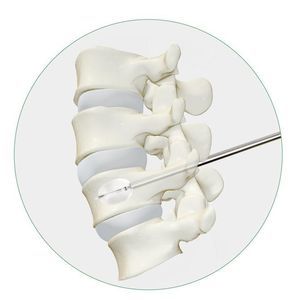 sistema di aumento vertebrale palloncino 1