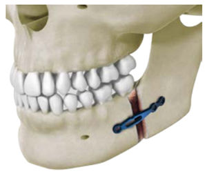 placca per osteotomia per mandibola