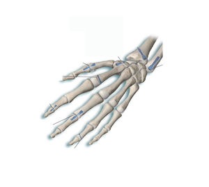 vite per compressione ossea per falange della mano