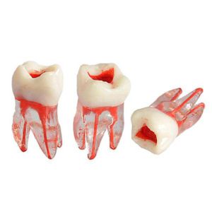 modello anatomico di canale radicolare