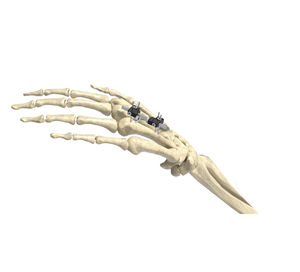 fissatore esterno per articolazione metacarpo-falangea 1