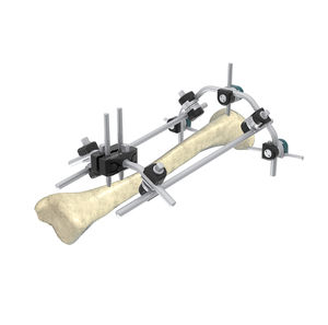 fissatore esterno per tibia 1