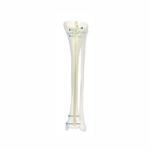 chiodo intramidollare per tibia 1