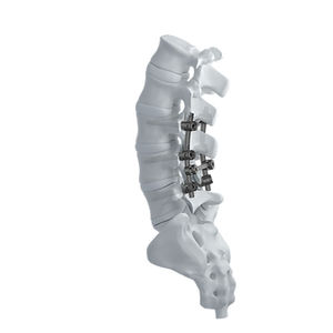 sistema di osteosintesi lombare
