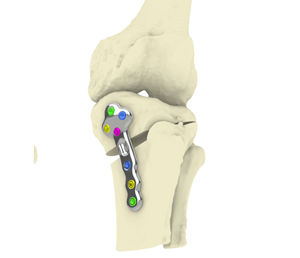 placca per osteotomia per tibia