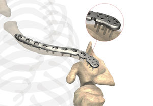 placca di compressione per clavicola