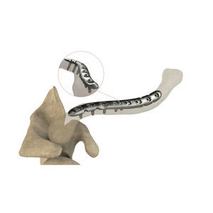 placca di compressione per clavicola