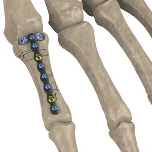 placca di compressione per articolazione metacarpo-falangea 1