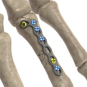 placca di compressione per falange della mano