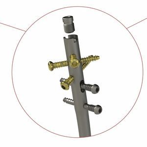 chiodo intramidollare per tibia