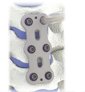 placca per artrodesi per vertebra cervicale