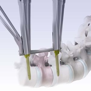 sistema di posizionamento di viti peduncolari mininvasivo