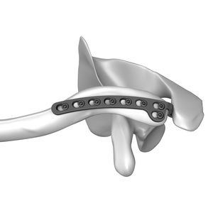 placca di compressione per clavicola 1