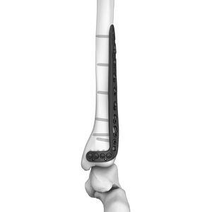 placca di compressione per tibia