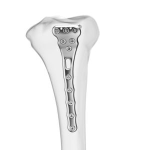 placca di compressione per tibia