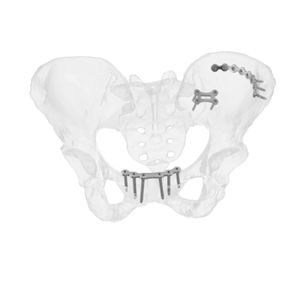 placca di compressione per bacino