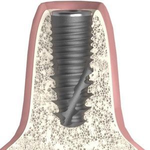 impianto dentale cilindrico conico