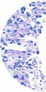 kit di test del cancro del polmone
