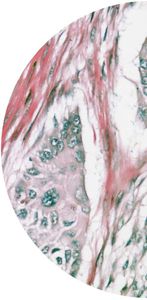 kit di test del tumore del pancreas