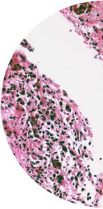 kit di test del glioma