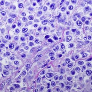kit di test per linfoma
