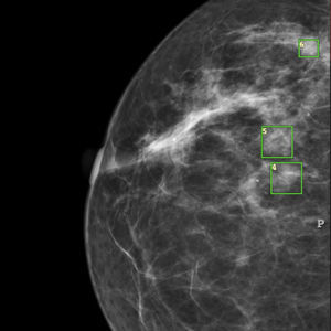software per screening del tumore al seno