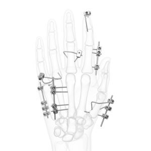 fissatore esterno per articolazione metacarpo-falangea 1