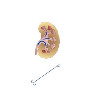 guaina di accesso ureterale
